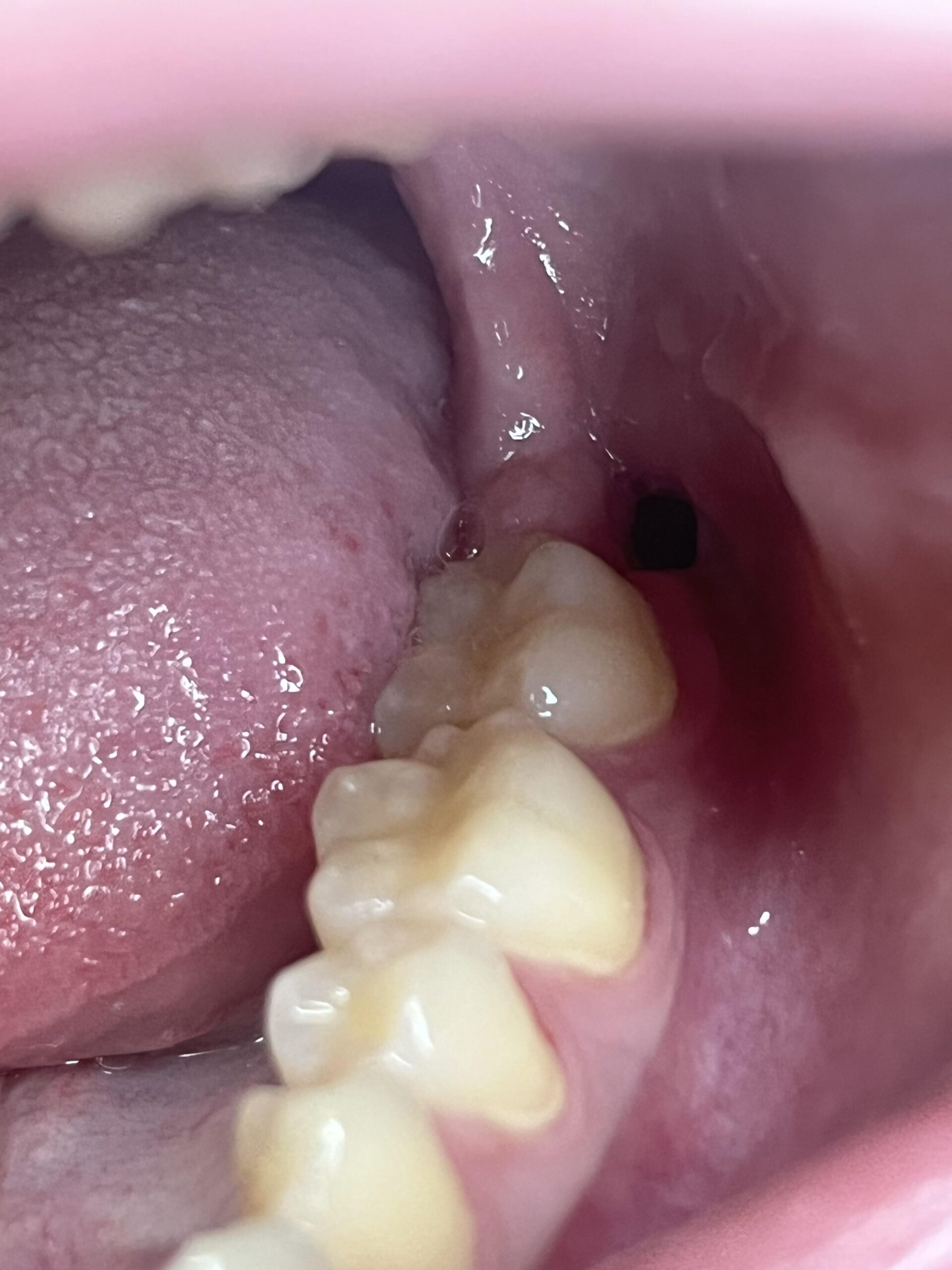 Is There a Hole After Wisdom Tooth Extraction