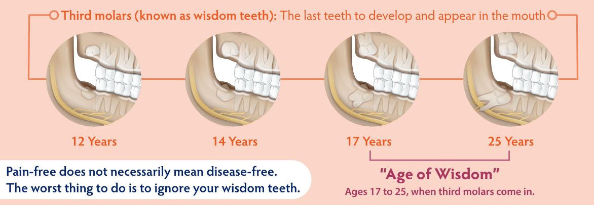 Pain Where Wisdom Tooth was Removed Years Later