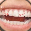 How to Fix a Cracked Tooth Naturally