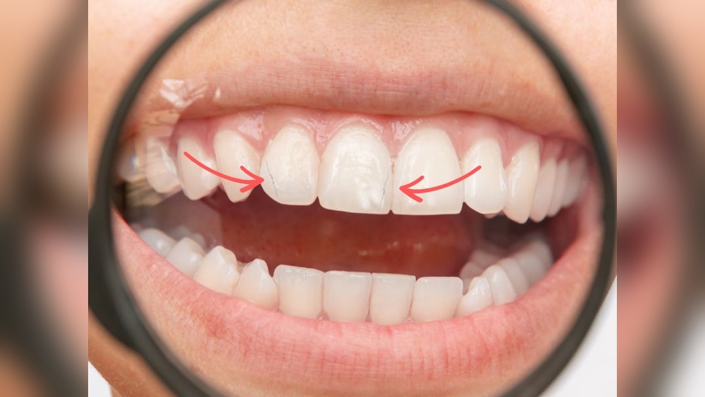 How to Fix a Cracked Tooth Naturally