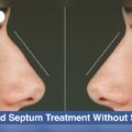 How to Fix a Deviated Septum Without Surgery