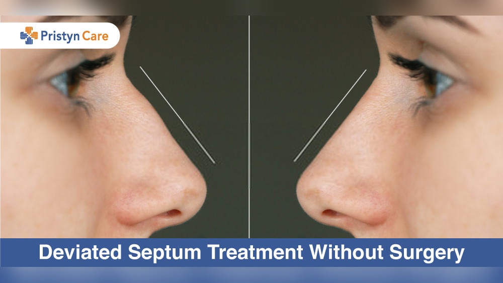 How to Fix a Deviated Septum Without Surgery