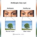 How to Fix a Lazy Eye