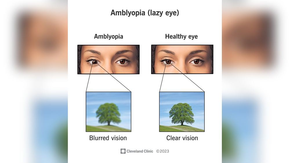 How to Fix a Lazy Eye