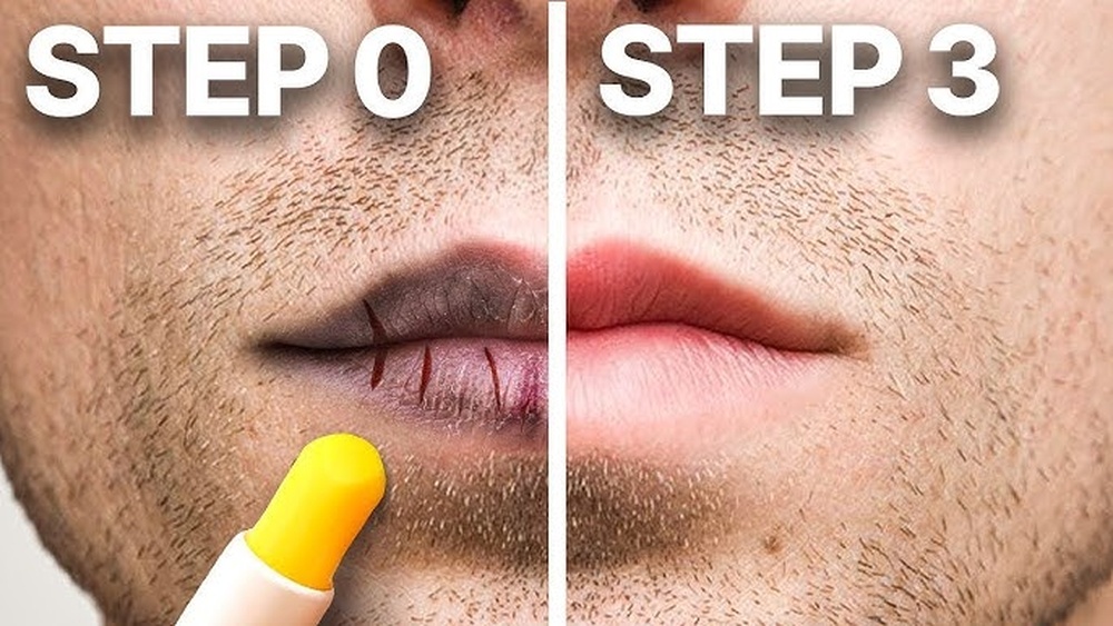 How to Fix Chapped Lips