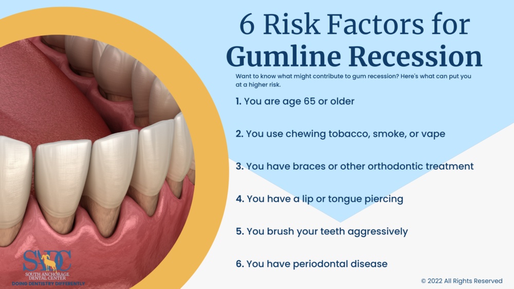 How to Fix Receding Gums​